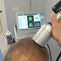 Alzheimer, a Torre del Greco al via la stimolazione transcranica ad onde d'urto: primo centro nel Sud Italia